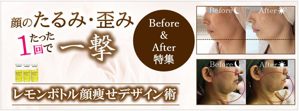 福岡 筑紫野・大野城、鹿児島のレモンボトルで小顔の例