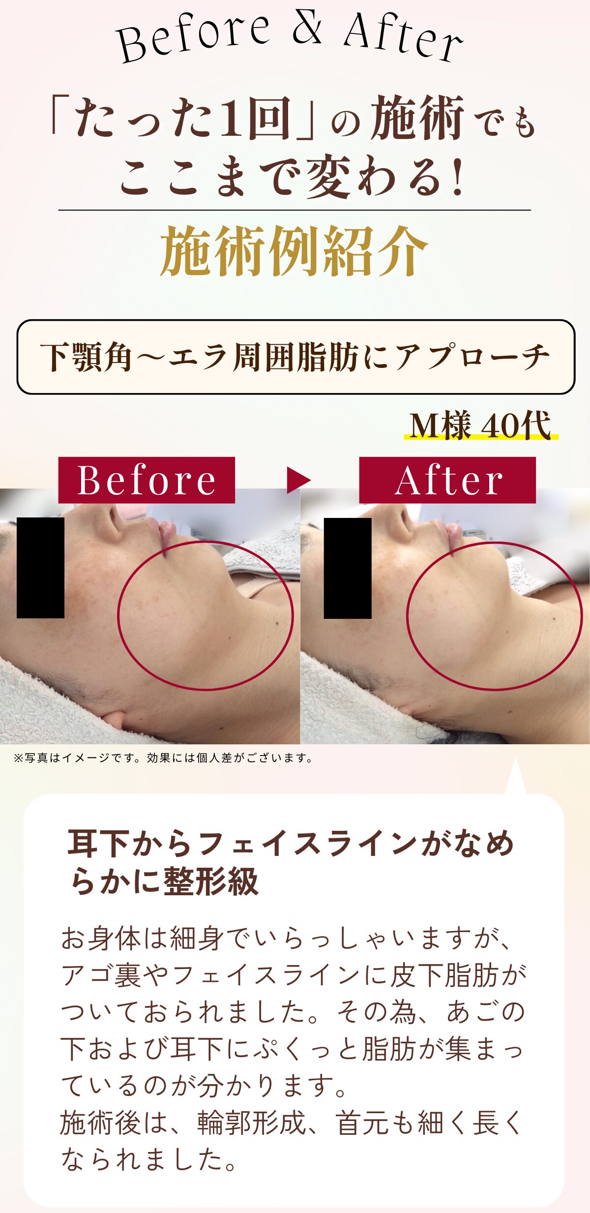 福岡・鹿児島のレモンボトル小顔矯正の比較写真1