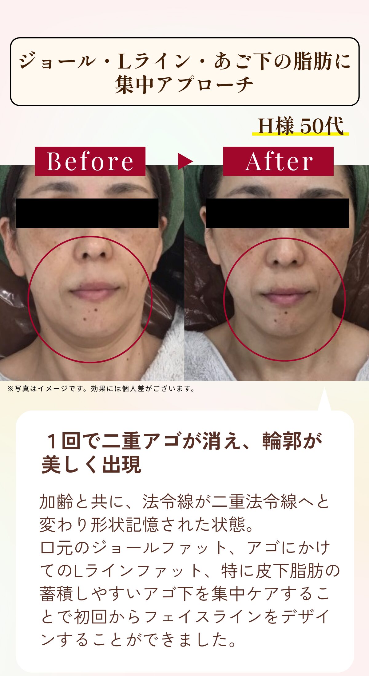 福岡・鹿児島のレモンボトル小顔矯正の比較写真2