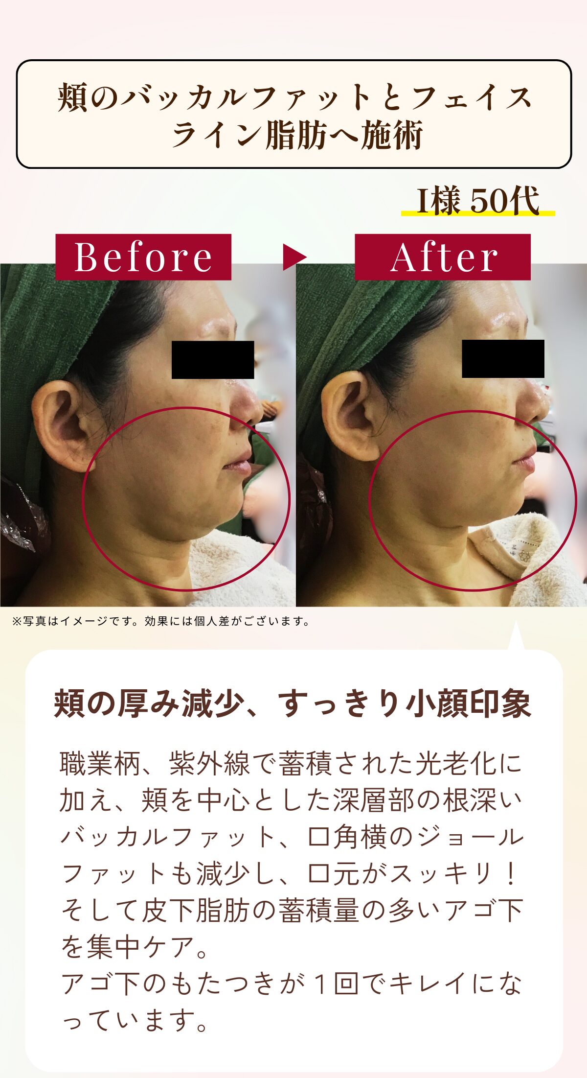 福岡・鹿児島のレモンボトル小顔矯正の比較写真3