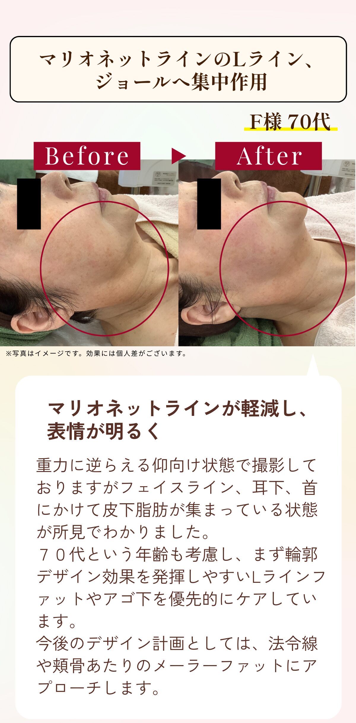 福岡・鹿児島のレモンボトル小顔矯正の比較写真4