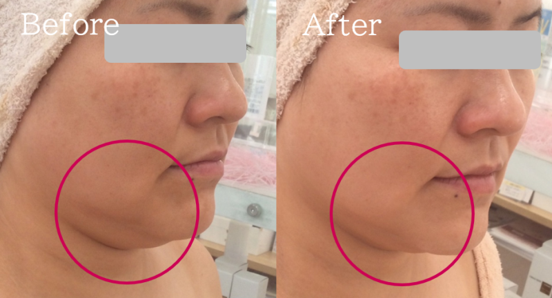 福岡 筑紫野・大野城、鹿児島のレモンボトルで小顔の例01