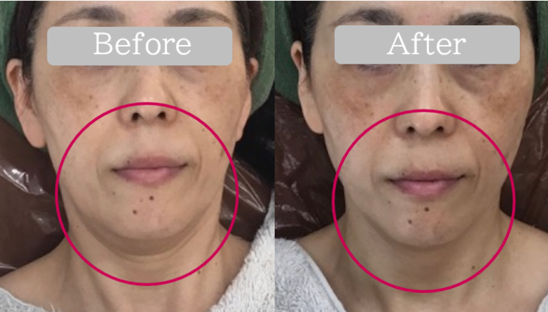 福岡 筑紫野・大野城、鹿児島のレモンボトルで小顔の例02