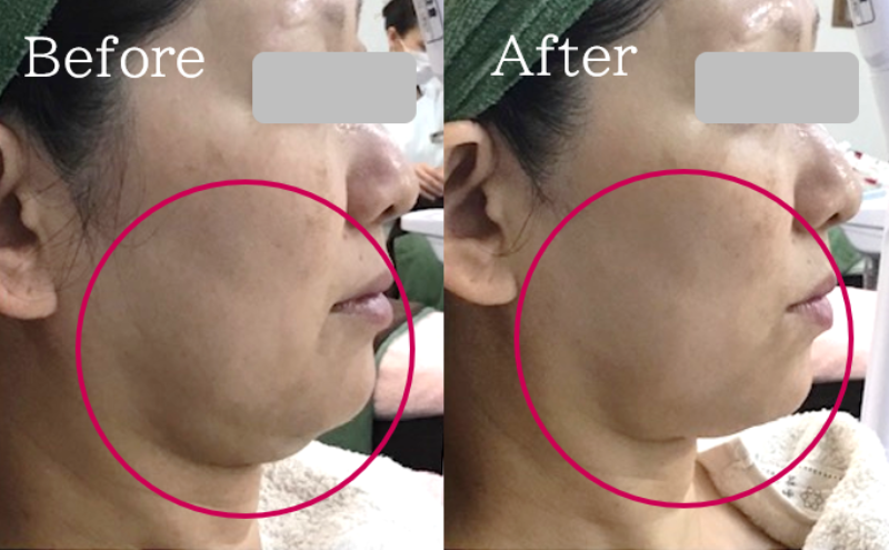 福岡 筑紫野・大野城、鹿児島のレモンボトルで小顔の例03