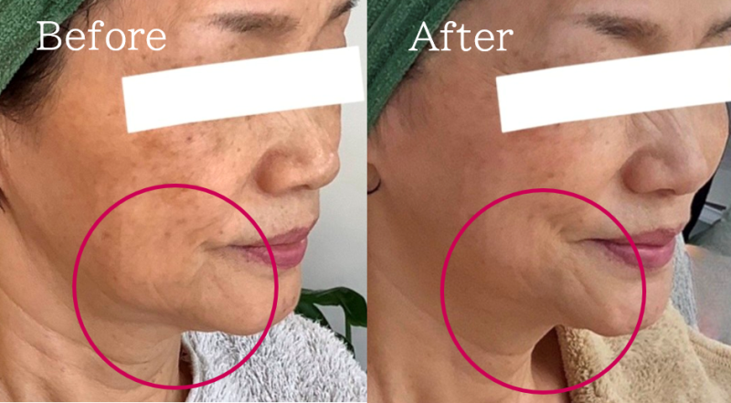 福岡 筑紫野・大野城、鹿児島のレモンボトルで小顔の例04