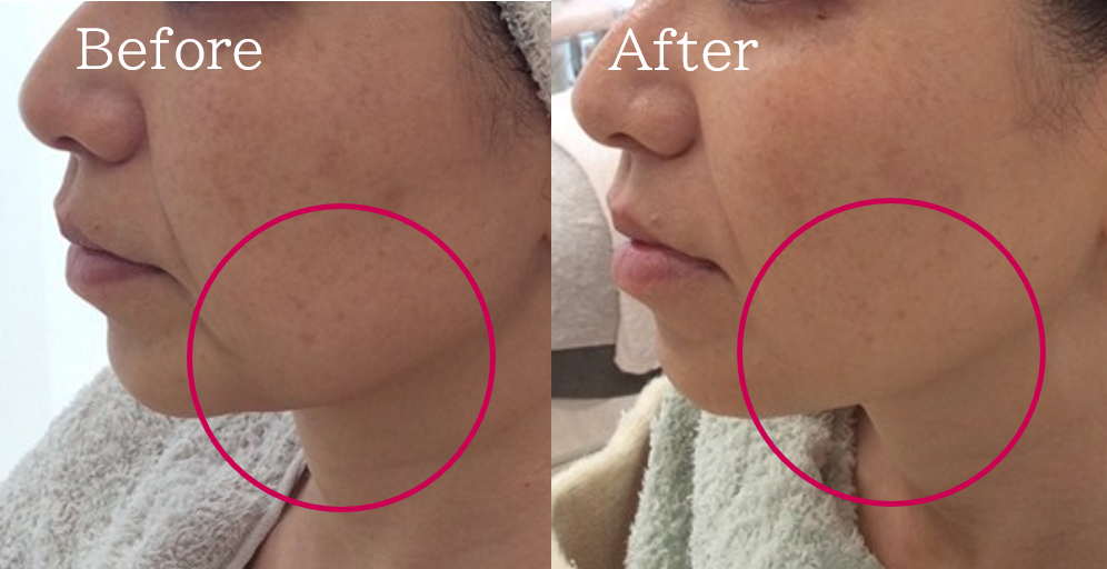 福岡 筑紫野・大野城、鹿児島のレモンボトルで小顔の例05