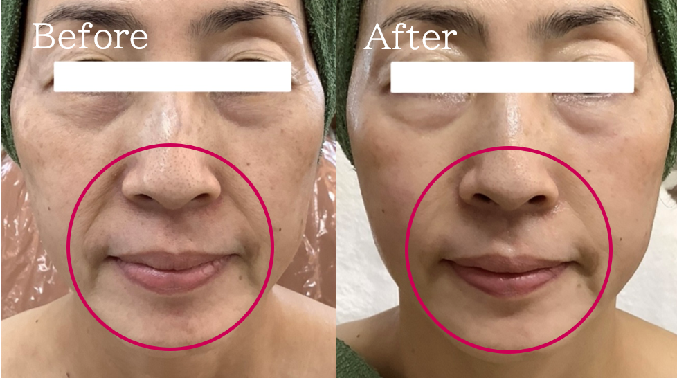 福岡 筑紫野・大野城、鹿児島のレモンボトルで小顔の例09