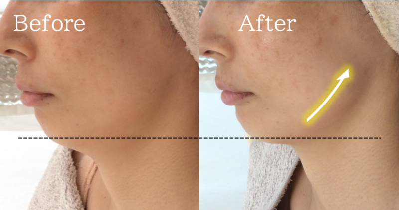 福岡 筑紫野・大野城、鹿児島のレモンボトルで小顔の例06