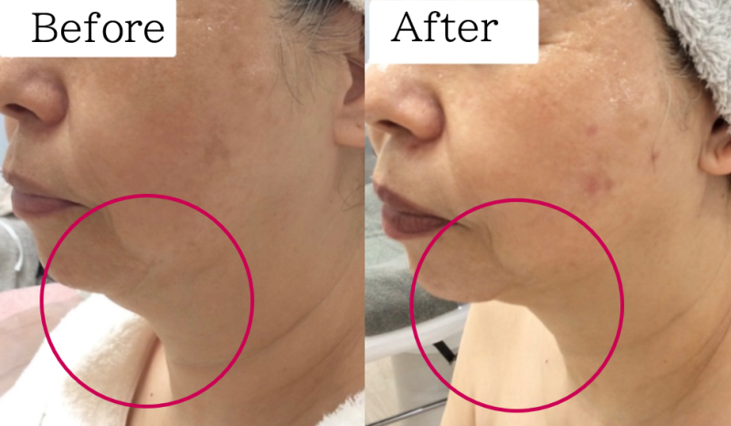 福岡 筑紫野・大野城、鹿児島のレモンボトルで小顔の例10