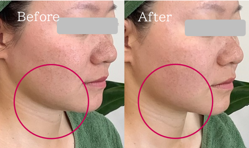 福岡 筑紫野・大野城、鹿児島のレモンボトルで小顔の例07