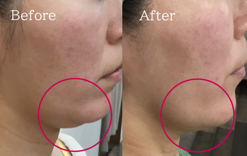 福岡 筑紫野・大野城、鹿児島のレモンボトルで小顔の例07