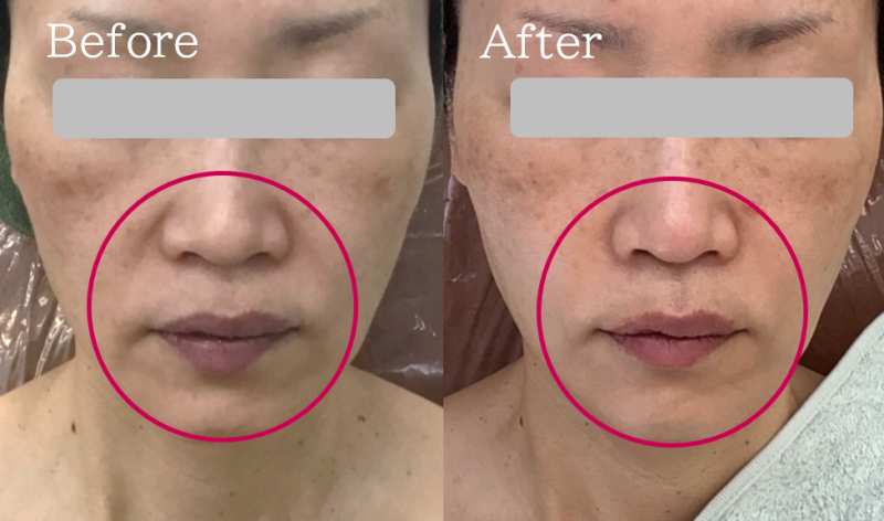 福岡 筑紫野・大野城、鹿児島のレモンボトルで小顔の例08