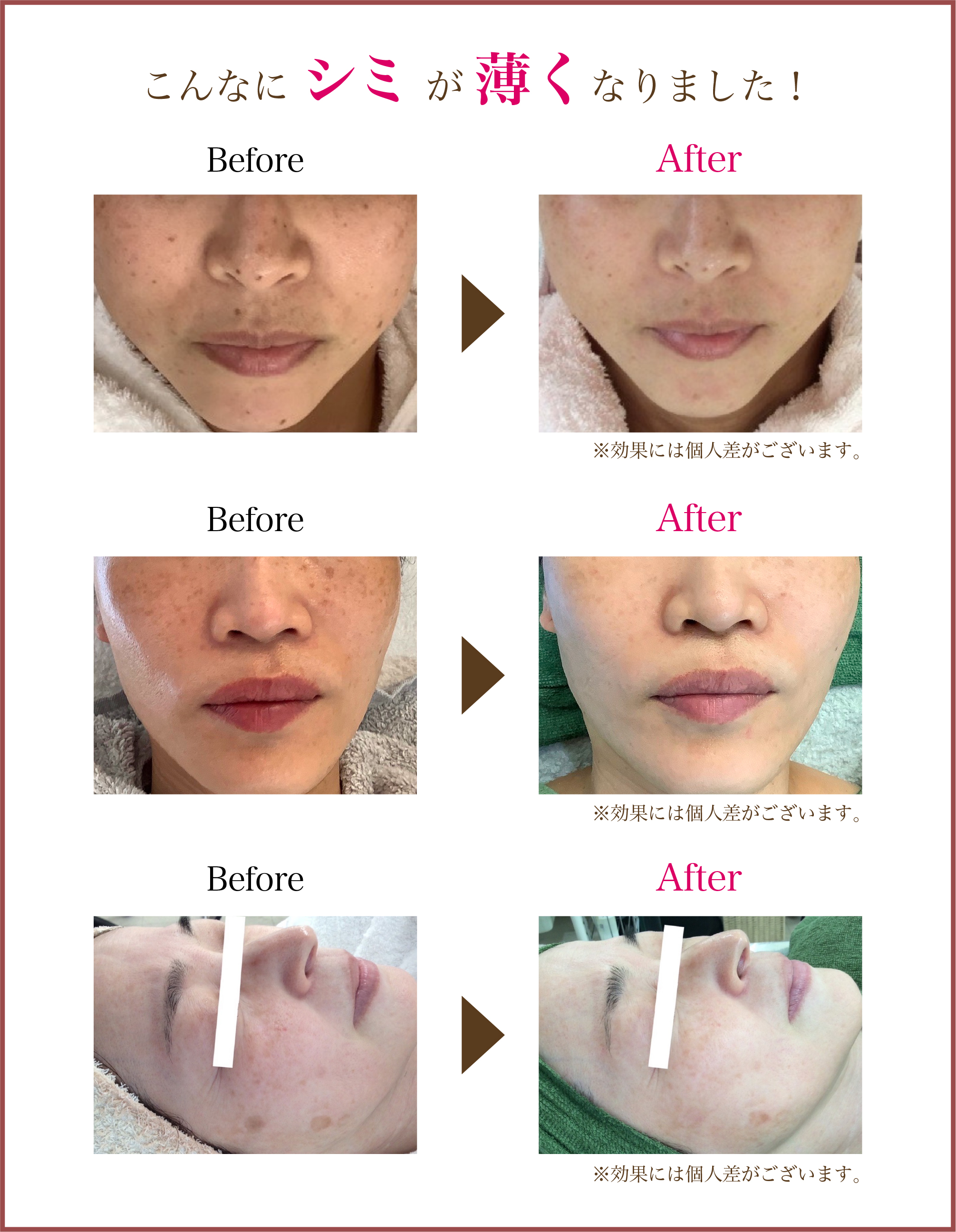 福岡・大野城・筑紫野・鹿児島のシミ取りエステでこんなにシミが薄くなりました！