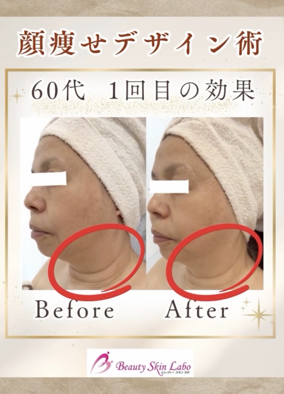 \ ラボの伝統と名医の革新 /〜✨顔痩せデザイン術✨〜　