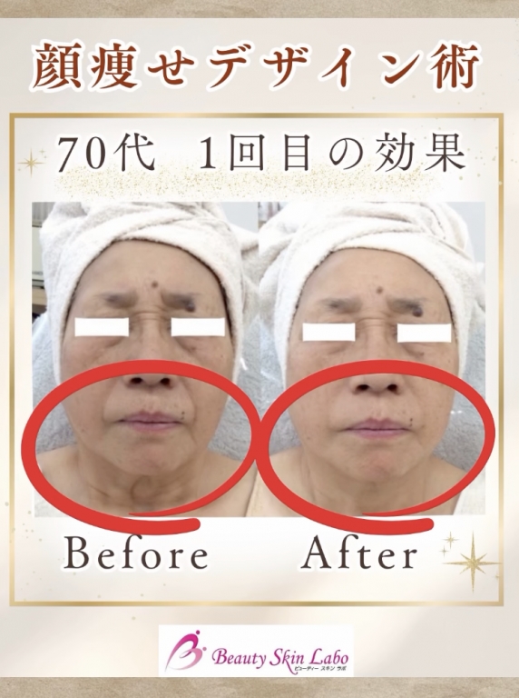\ ラボの伝統と名医の革新 /〜✨顔痩せデザイン術✨〜　